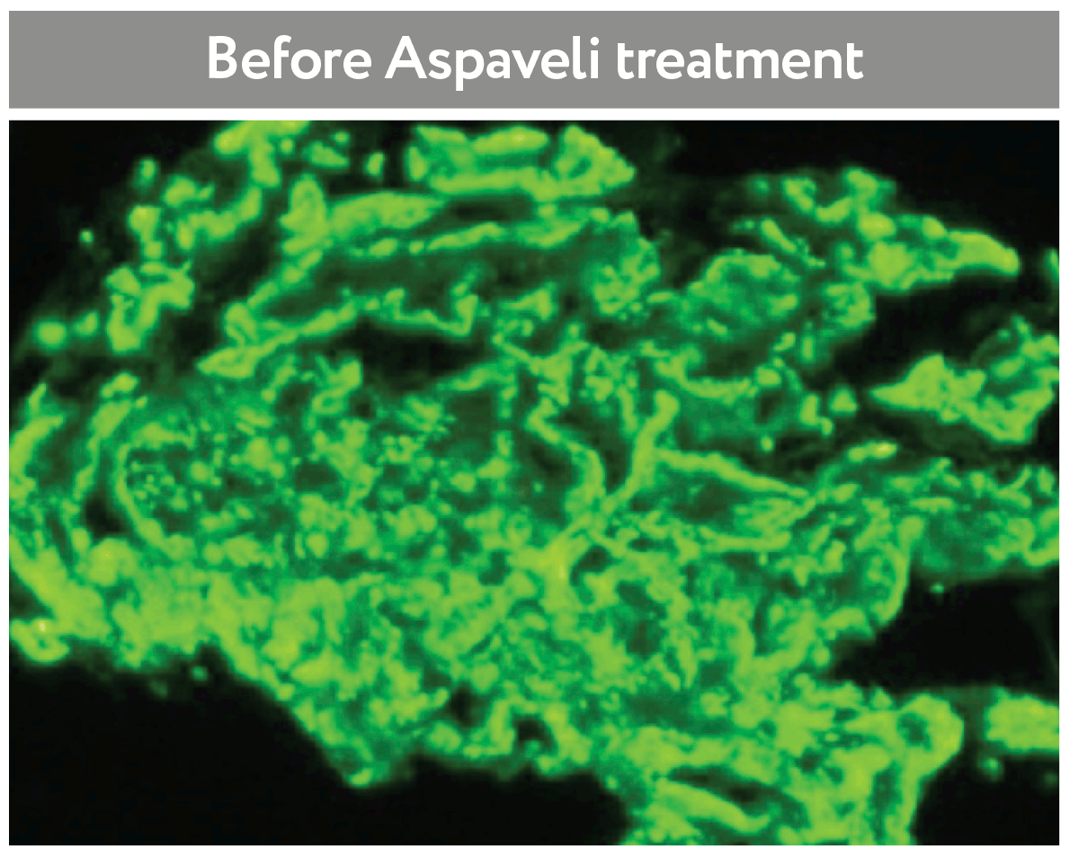 Before Aspaveli treatment