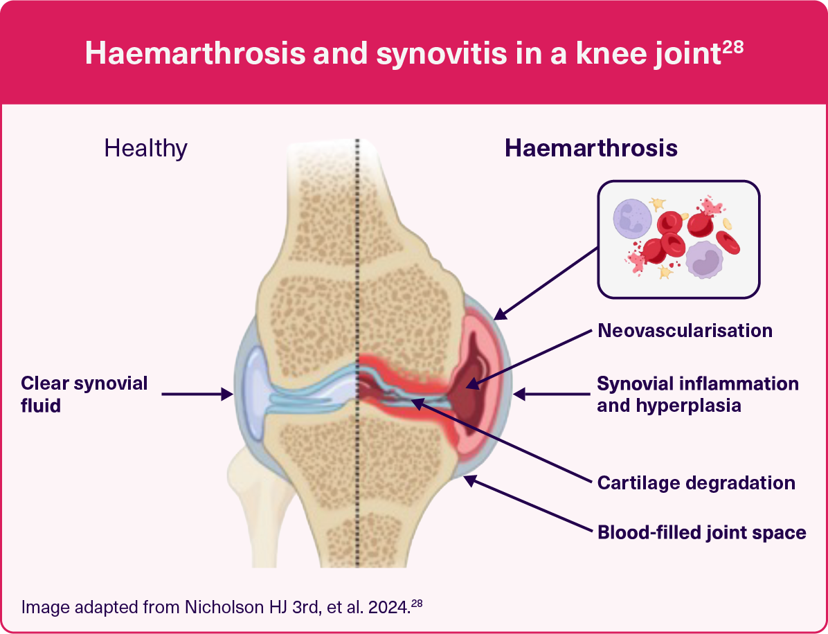 Haemarthrosis-synovitis-knee