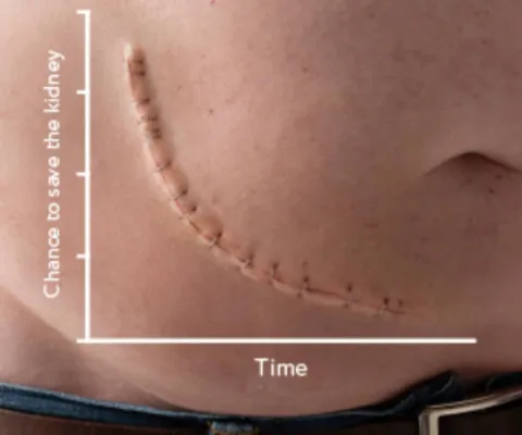 Renal scar