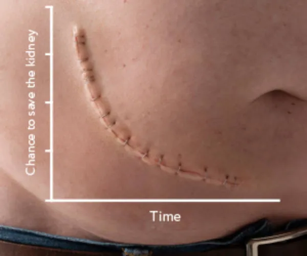Renal scar